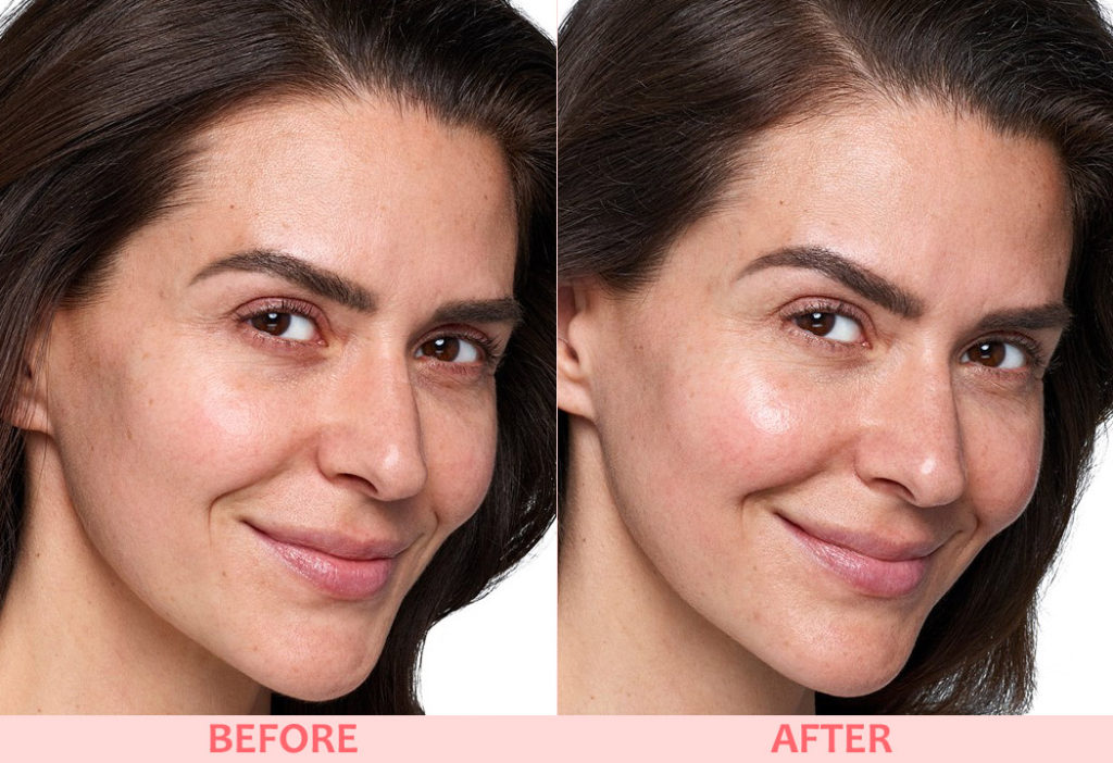 SkinVive before-after