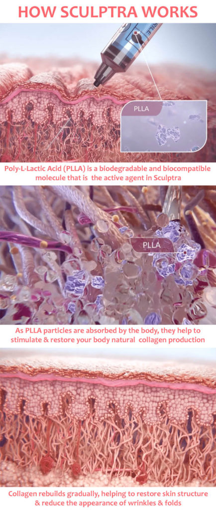 How Does Sculptra Work?