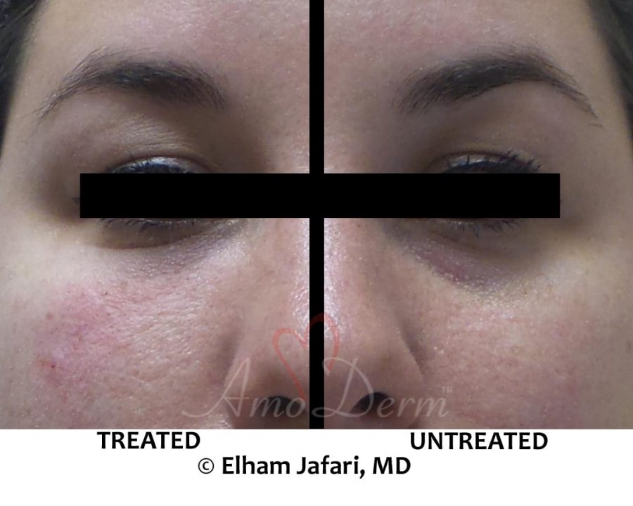 Nonsurgical treatment of dark circles, bags and hollows under the eyes