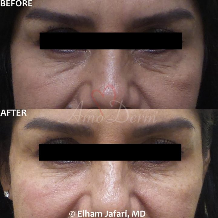 Nonsurgical treatment of dark circles, bags and hollows under the eyes