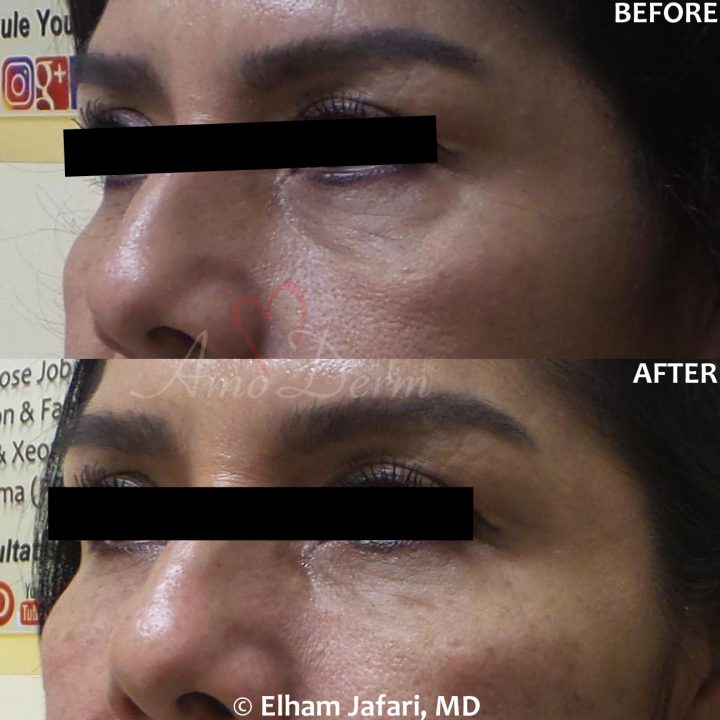 Nonsurgical treatment of dark circles, bags and hollows under the eyes