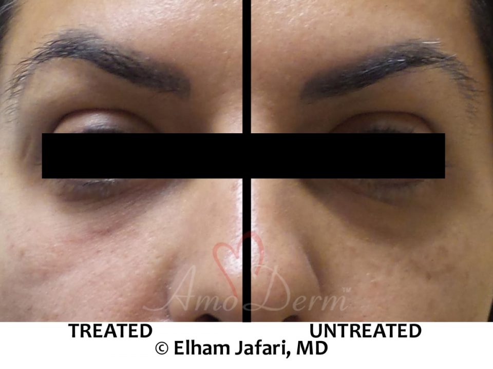 Nonsurgical treatment of dark circles, bags and hollows under the eyes