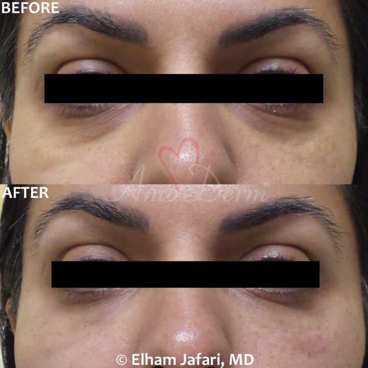 Nonsurgical treatment of dark circles, bags and hollows under the eyes