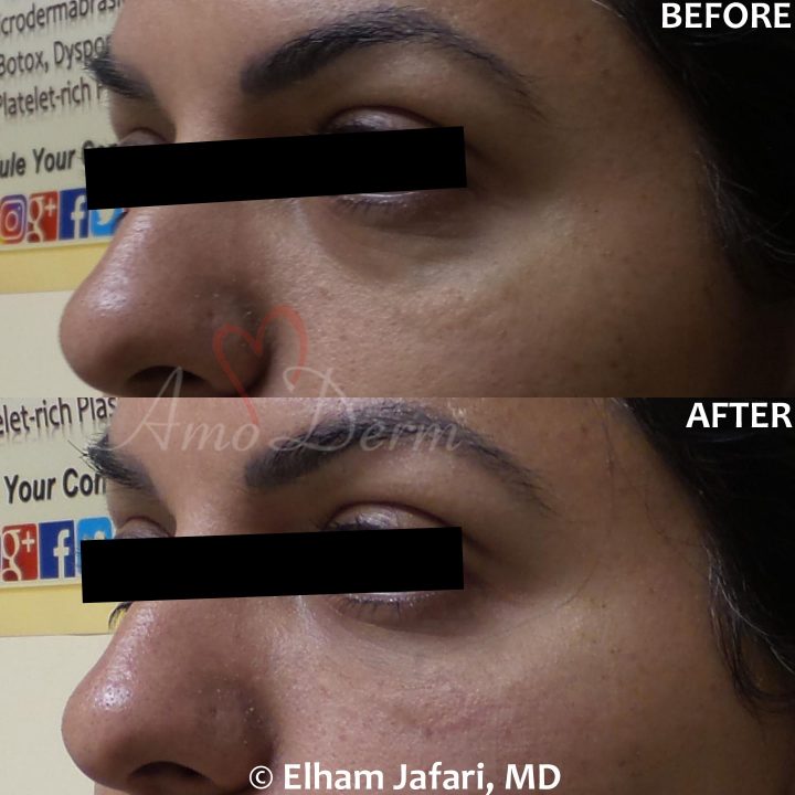 Nonsurgical treatment of dark circles, bags and hollows under the eyes