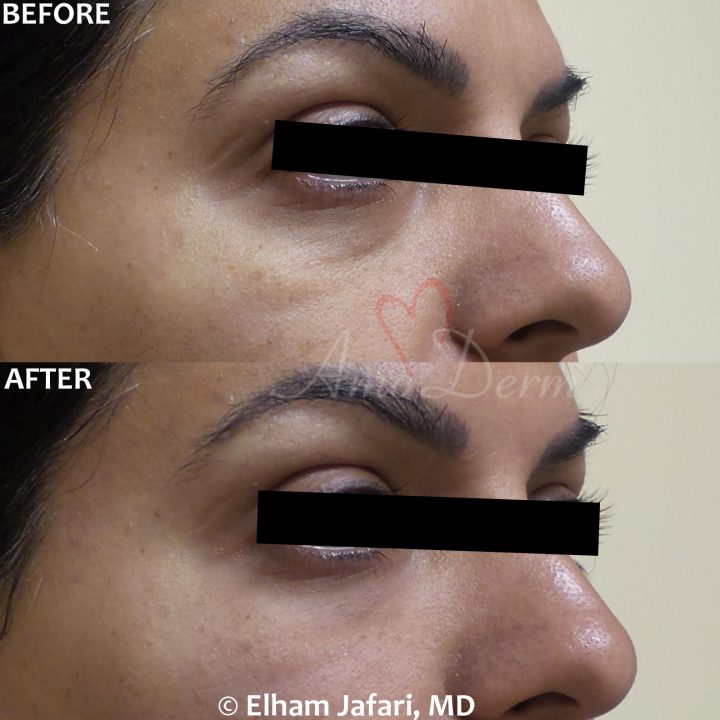 Nonsurgical treatment of dark circles, bags and hollows under the eyes