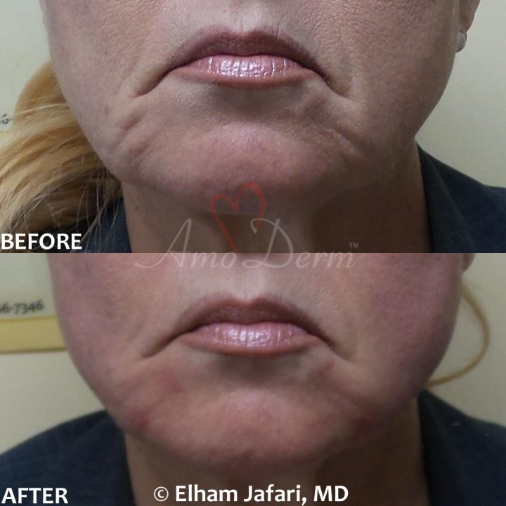 Filler and PDO thread lift for jawline