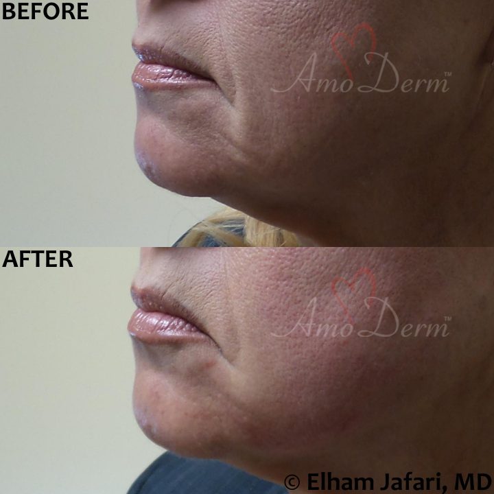 Filler and PDO thread lift for jawline