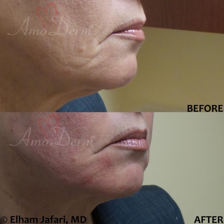 Filler and PDO thread lift for jawline