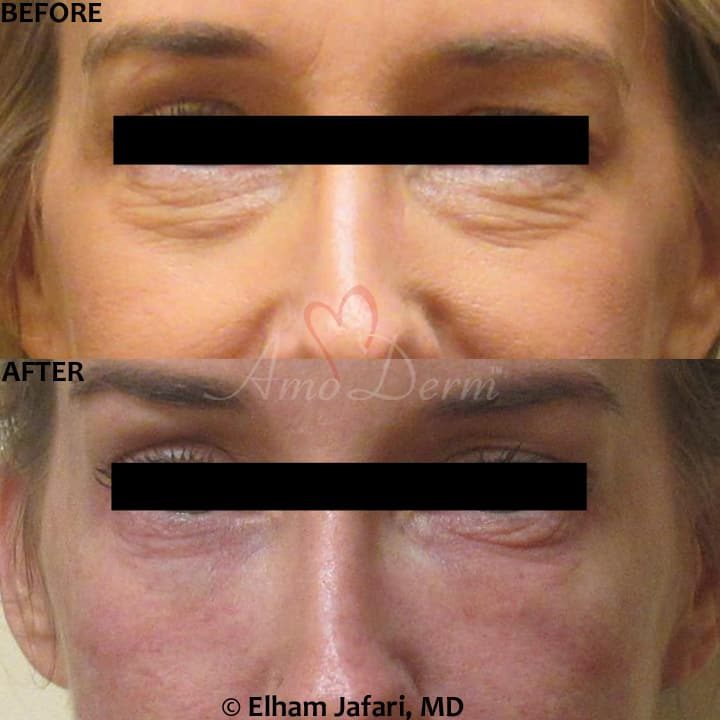 Nonsurgical treatment of dark circles, bags and hollows under the eyes