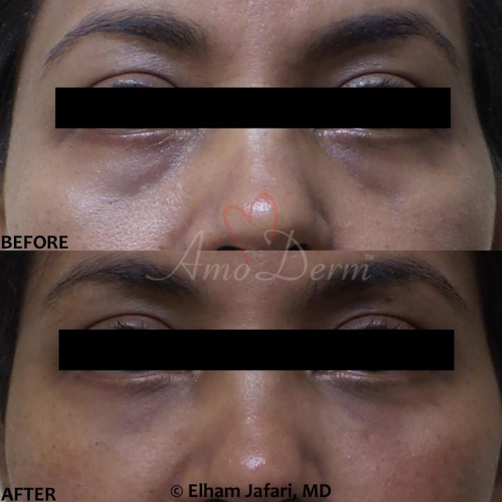 Nonsurgical treatment of dark circles, bags and hollows under the eyes