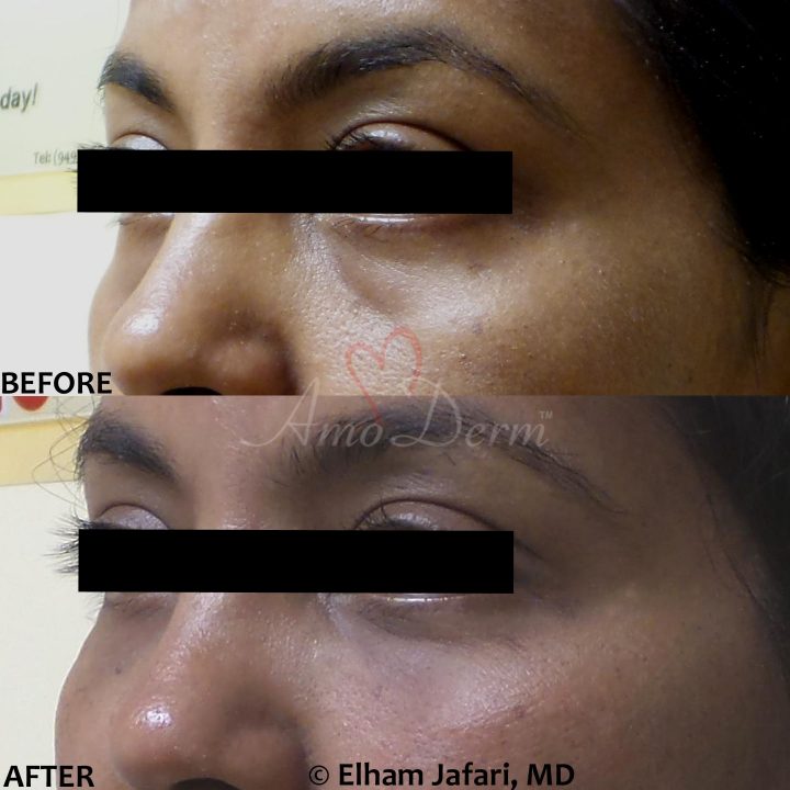 Nonsurgical treatment of dark circles, bags and hollows under the eyes