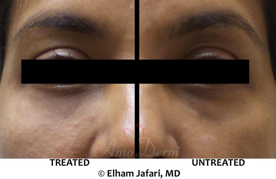 Nonsurgical treatment of dark circles, bags and hollows under the eyes