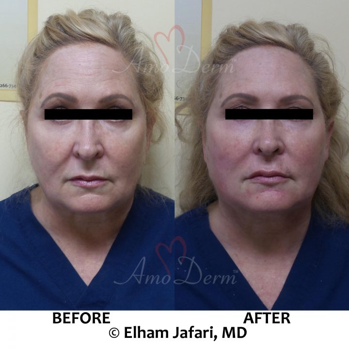 Liquid Facelift with PDO threads &amp; filler injection in cheeks and under the eyes