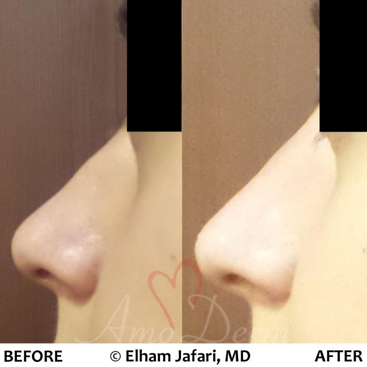 Non-surgical nose job with injection of dermal fillers