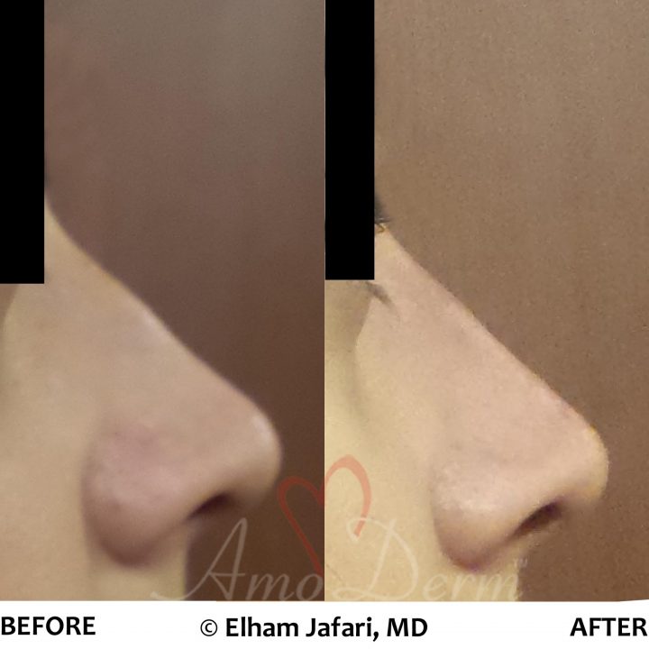 Non-surgical nose job with injection of dermal fillers