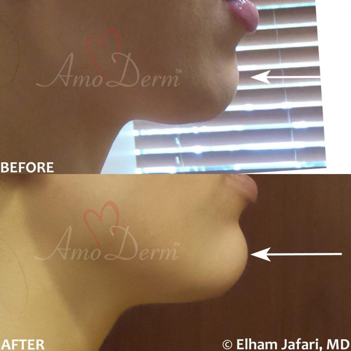 Chin augmentation and enhancement with filler injection (Voluma, Bellafill, Radiesse)