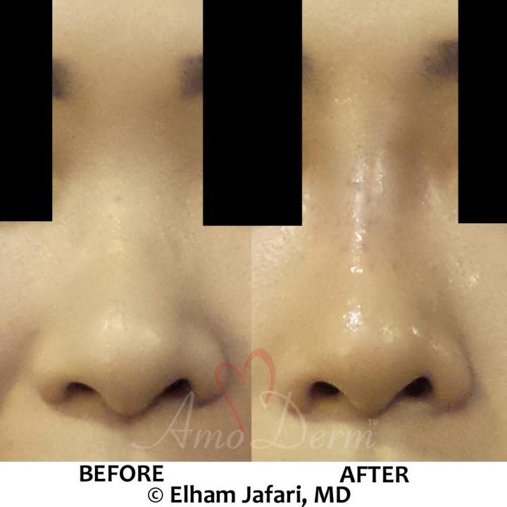 Nonsurgical nose job with injection of dermal fillers