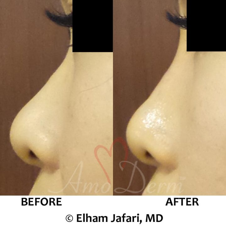 Nonsurgical nose job with injection of dermal fillers