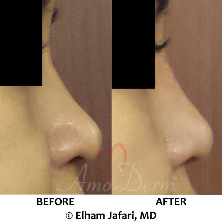 Non-surgical nose job with injection of dermal fillers