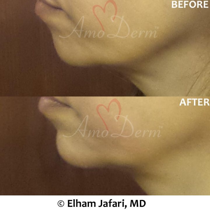 Chin augmentation and enhancement with filler injection (Voluma, Bellafill, Radiesse)