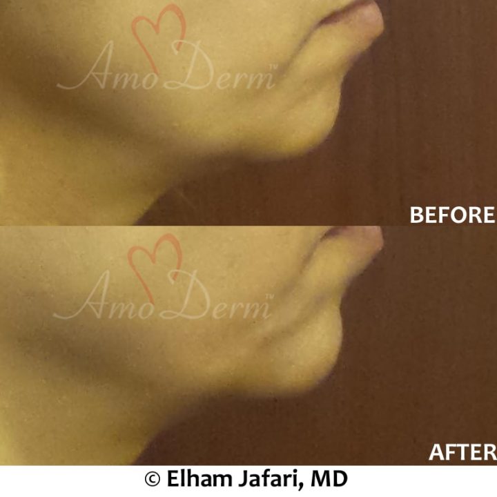 Chin augmentation and enhancement with filler injection (Voluma, Bellafill, Radiesse)