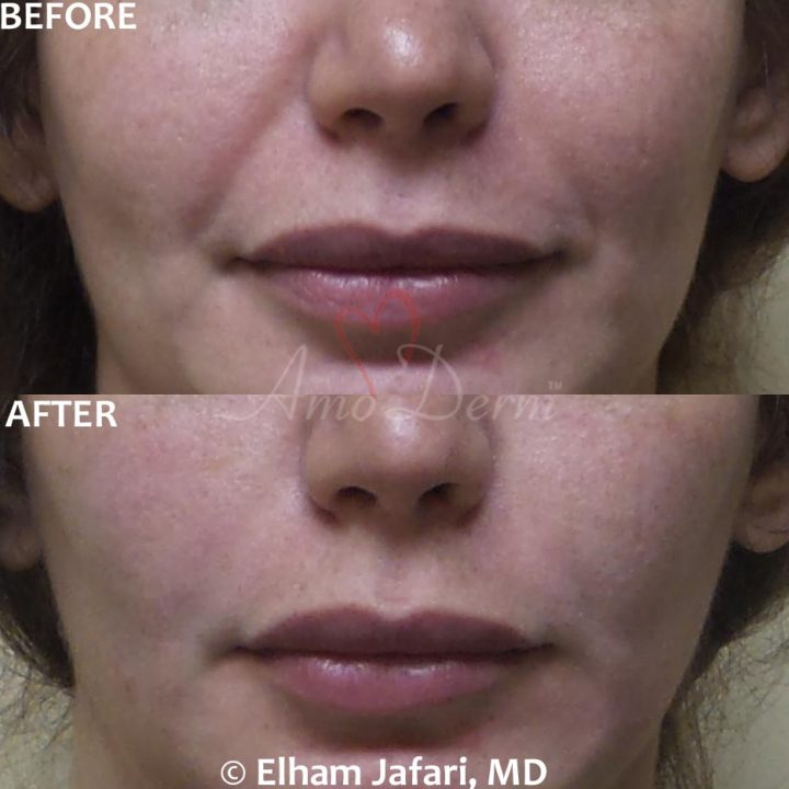 Treatment of nasolabial folds as part of non-surgical facelift