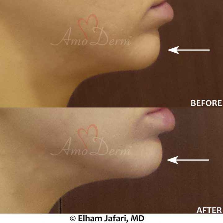 Chin augmentation and enhancement with filler injection (Voluma, Bellafill, Radiesse)