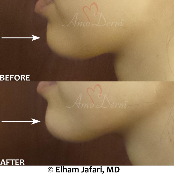 Chin augmentation and enhancement with filler injection (Voluma, Bellafill, Radiesse)