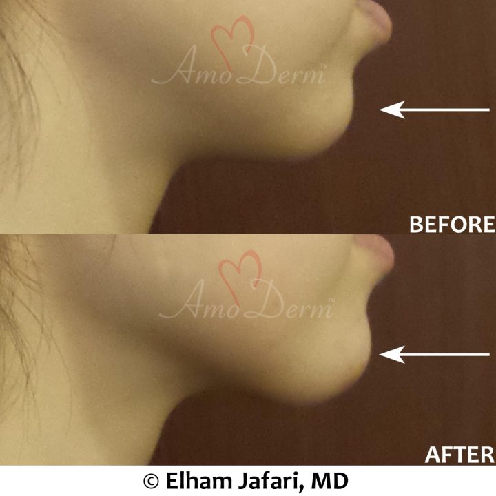 Chin augmentation and enhancement with filler injection (Voluma, Bellafill, Radiesse)