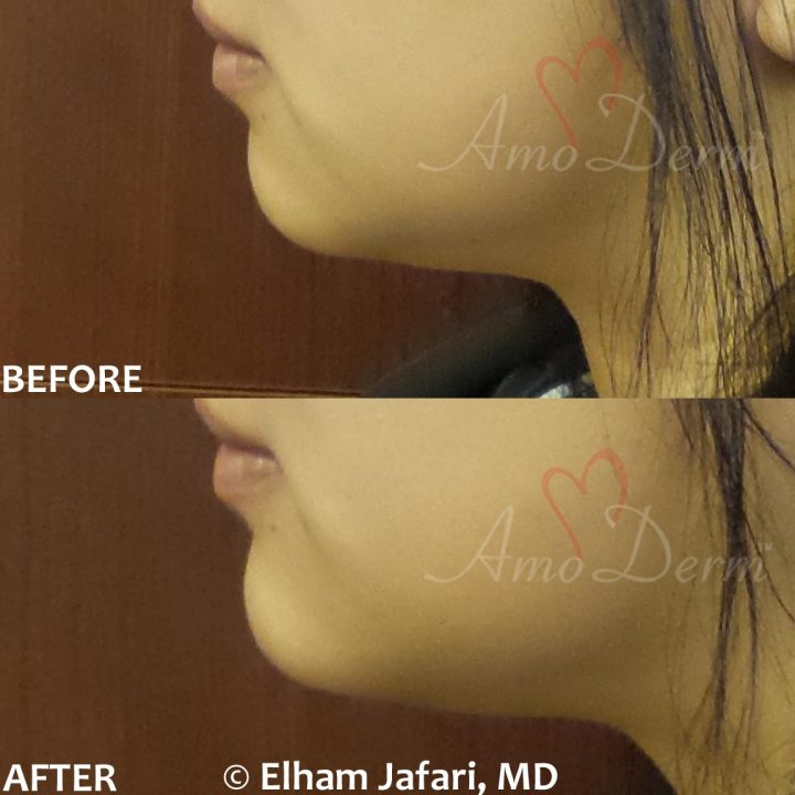 Non surgical chin augmentation and enhancement