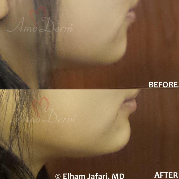 Non surgical chin augmentation and enhancement