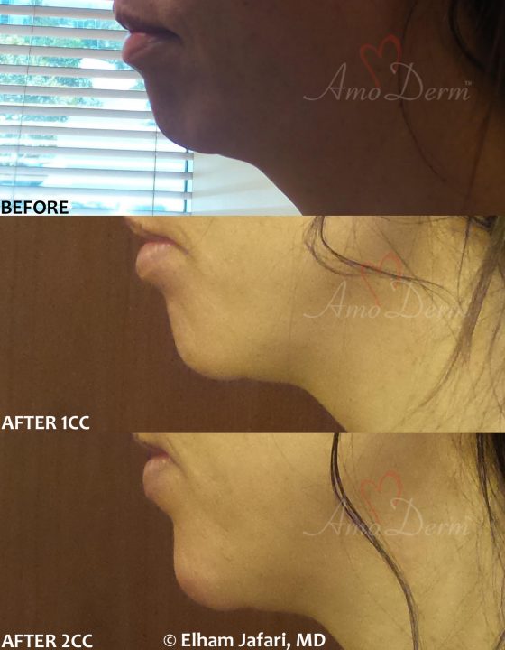 Chin augmentation and enhancement with filler injection (Voluma, Bellafill, Radiesse)