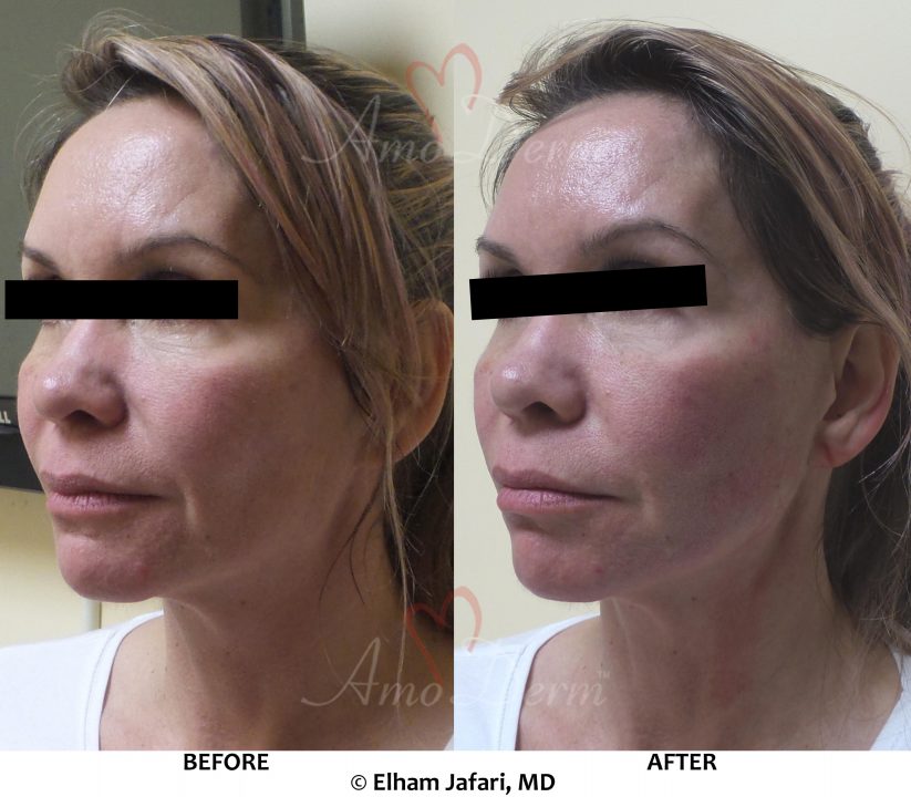 Liquid Facelift with PDO Thread (thread lift) in mid and lower face