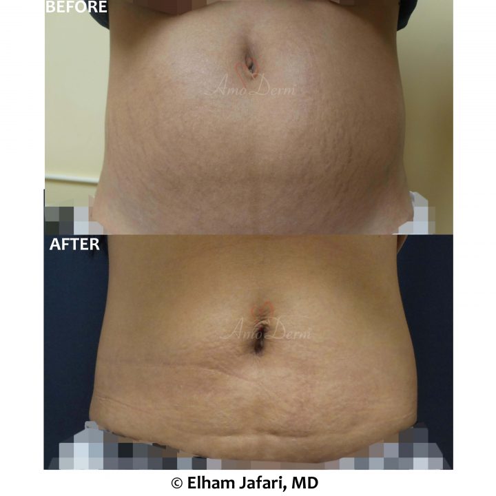 Treatment of stretch marks with CO2 laser &amp; non-surgical removal of stubborn fat in belly with SculpSure