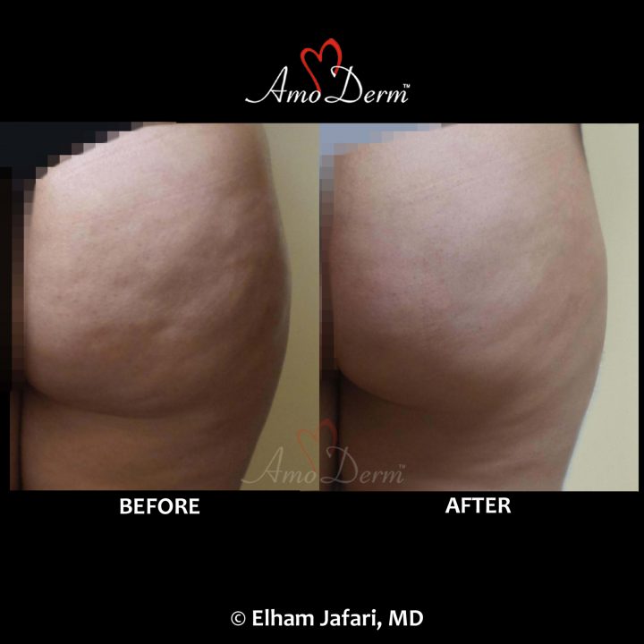 Cellulite treatment in buttocks with Sculptra filler injection as part of Brazilian Butt Lift