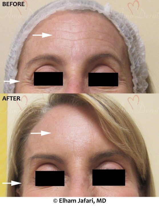 Botox in Forehead Crows Feet &amp; Glabella