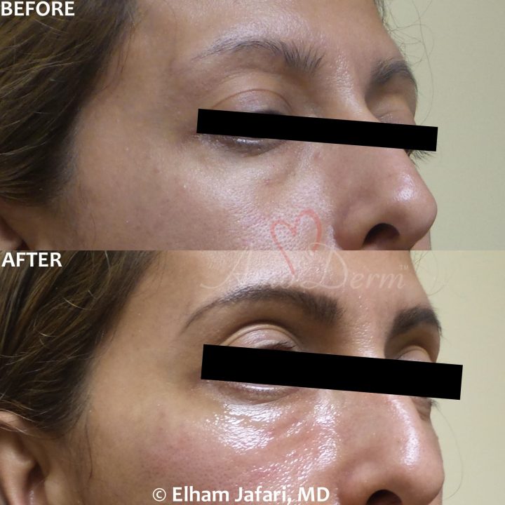 Treat dark circles & bags under eyes using fillers & lasers