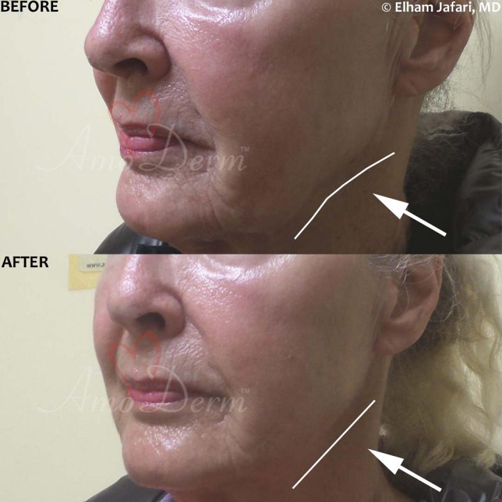 Orange County Radiesse - Irvine Radiesse Dermal Filler - Amoderm