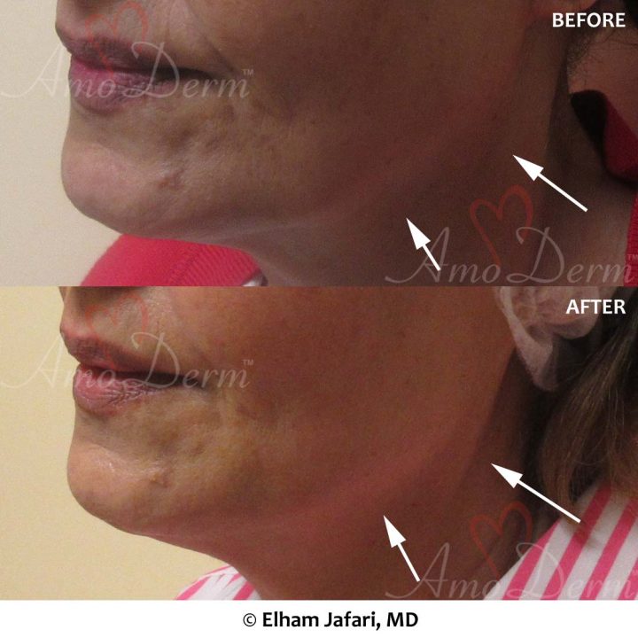 Jaw and Neck Lift