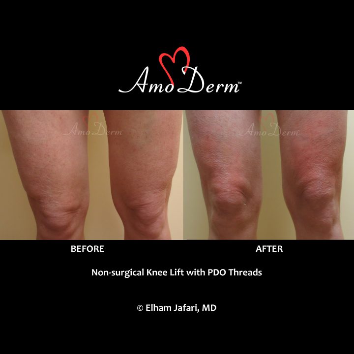 Non-surgical Knee Lift with PDO Threads Amoderm : Before &amp; After Gallery