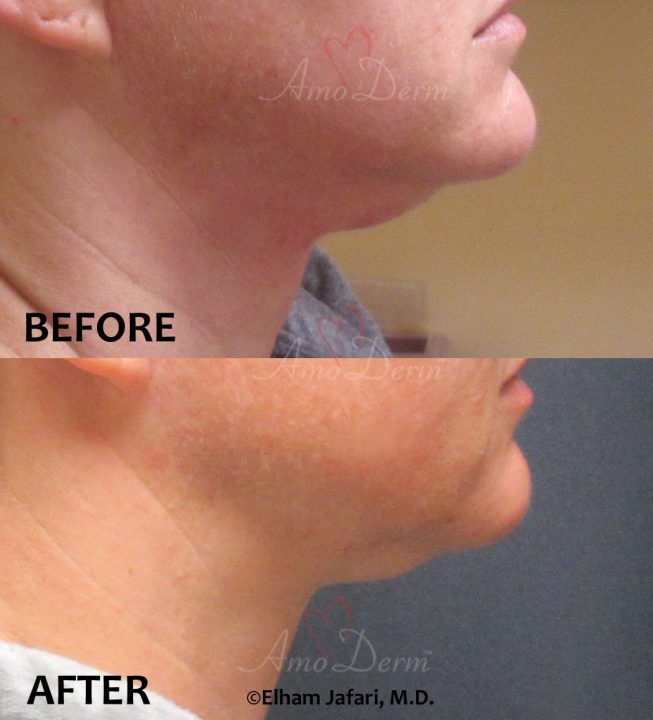 Non surgical &amp; permanent reduction of double chin (excessive submental fat) with Kybella