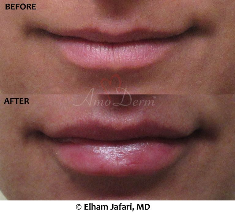 Lip Augmentation