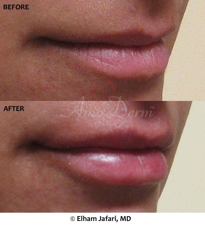 Lip Augmentation