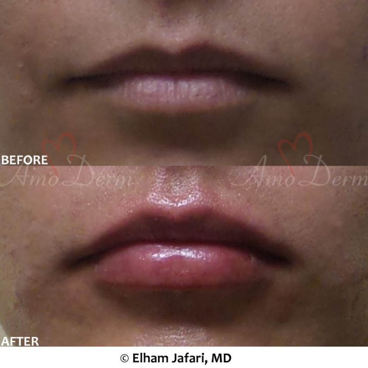 Lip Augmentation