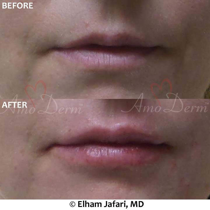 Lip Augmentation