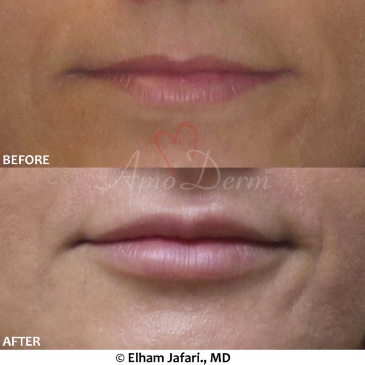 Lip Augmentation