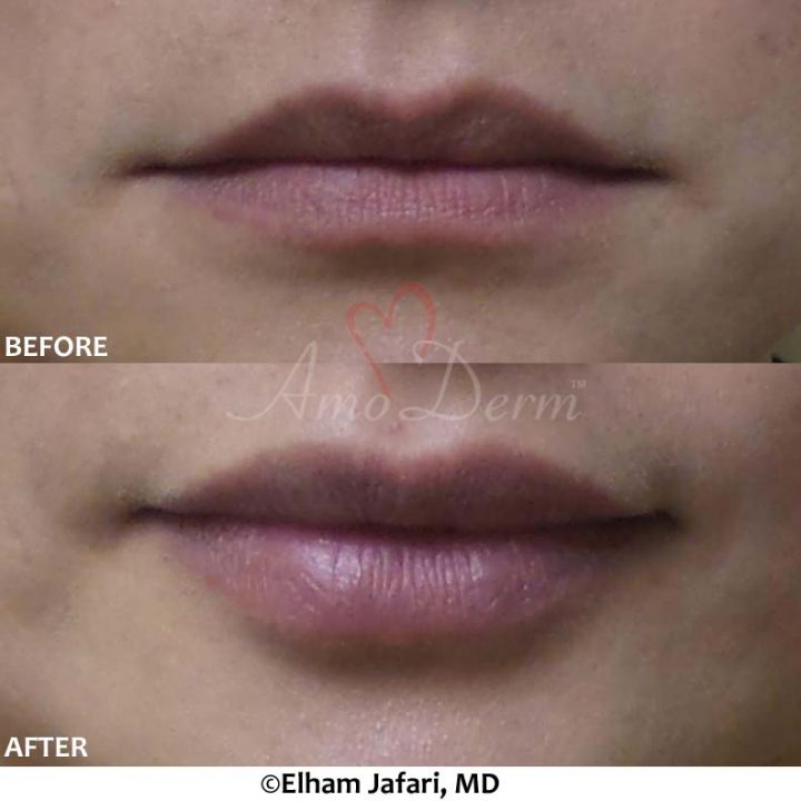 Lip Augmentation