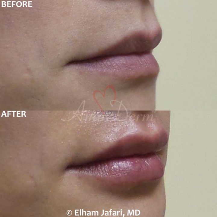 Lip Augmentation