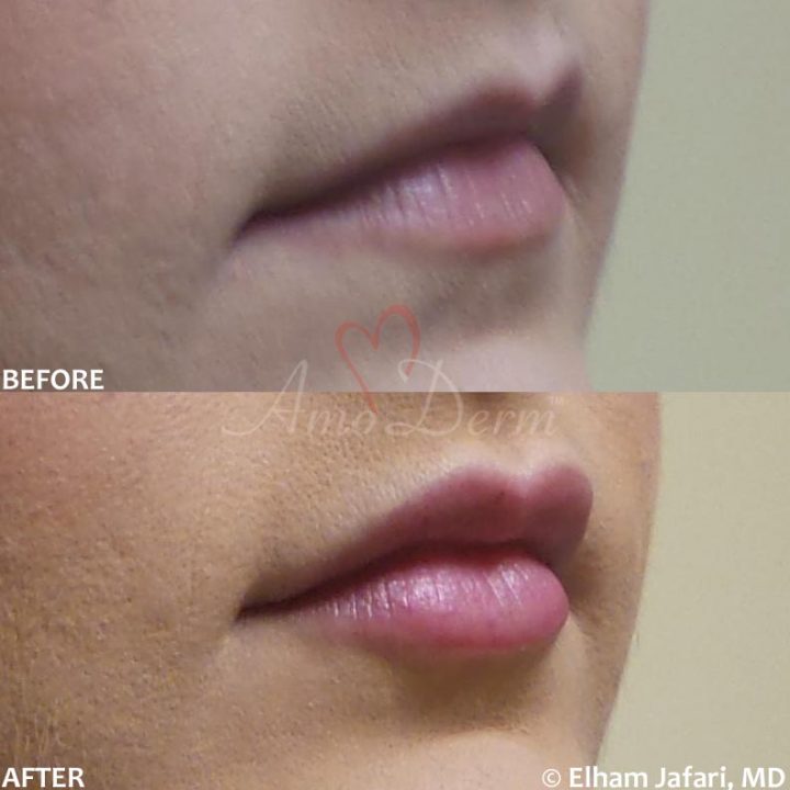 Lip Augmentation