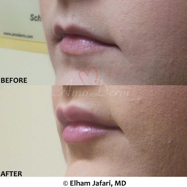 Lip Augmentation